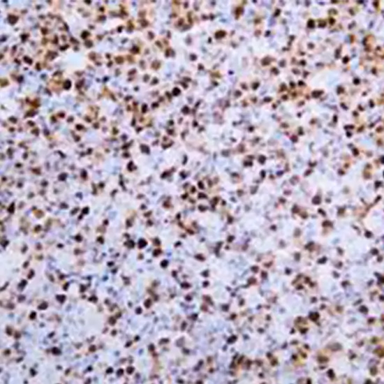 IHC - Multiple Myeloma Oncogene 1 (MUM1)